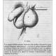 Raro Castrador de Testículos Quirúrgico Chassaignac del Siglo XIX - 20 cms